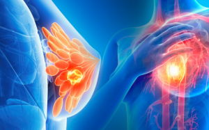 5 dấu hiệu ung thư vú dù không có khối u 