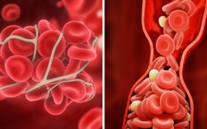 6 cách đơn giản giúp ngăn ngừa cục máu đông 