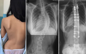 Cơ hội khám miễn phí cho trẻ em cong vẹo cột sống bởi chuyên gia Anh quốc