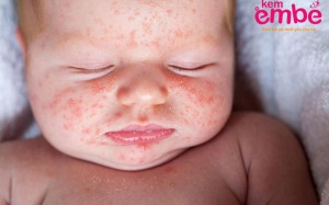 5 cách điều trị cho trẻ bị rôm sảy mùa nóng này