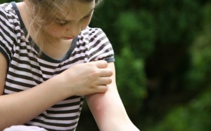 8 biện pháp tự nhiên giúp giảm ngứa, giảm đau khi bị côn trùng đốt