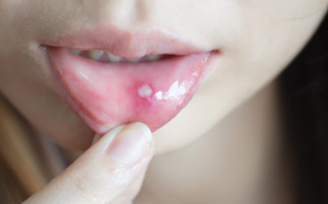 Nhiệt miệng, loét miệng do đâu, chữa thế nào?