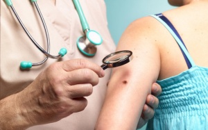 Ngoài nốt ruồi bất thường, đây là 5 dấu hiệu ung thư da dễ nhận biết