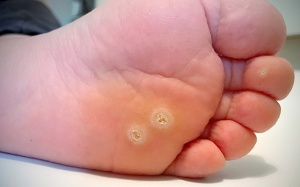 Mụn cóc ở lòng bàn chân tái phát phải điều trị thế nào?