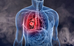 7 dấu hiệu của bệnh ung thư phổi không thể bỏ qua