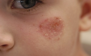 Làm sao để điều trị chốc lở ở trẻ em? 