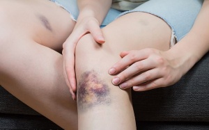 Vì sao chân dễ bị bầm tím dù không va chạm với vật gì?