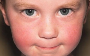 Nhận biết lupus ban đỏ qua ban cánh bướm