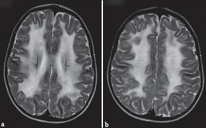 Hút thuốc lá làm tăng nguy cơ thoái hóa chất trắng ở não