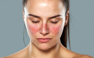 8 biện pháp tự nhiên giúp kiểm soát bệnh lupus