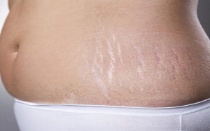 Da sần vỏ cam (cellulite): Làm sao cho hết?