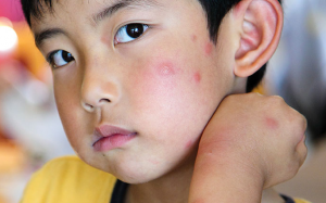 3 bước đơn giản giúp điều trị vết côn trùng cắn ở trẻ 