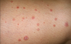 Những biện pháp đơn giản giúp kiểm soát bệnh vẩy nến