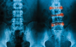 Viêm cột sống dính khớp là bệnh gì, ảnh hưởng thế nào?