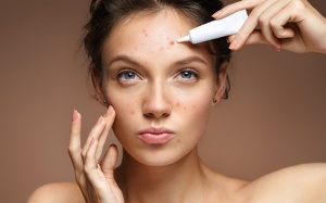 Mụn trứng cá ở người trưởng thành: Ăn uống thế nào để khắc phục?