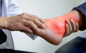 Người bị gout nên ăn gì uống gì?