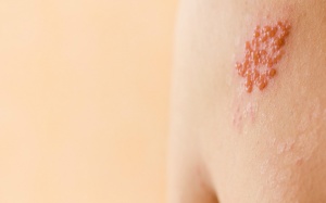 Nổi mụn nước nhỏ, đau rát bên sườn có phải giời leo?