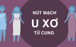 Nút mạch: Phương pháp điều trị u xơ tử cung không cần phẫu thuật