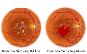 Laser có giúp giảm thoái hóa điểm vàng?
