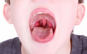 Video: Những điều bạn cần biết về viêm amidan