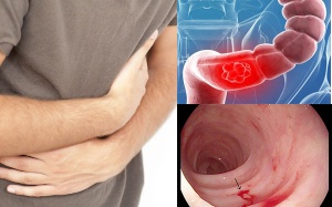 7 câu hỏi thường gặp về viêm loét đại tràng
