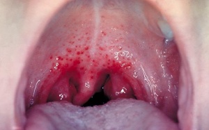 Những thông tin cần biết về viêm họng liên cầu khuẩn