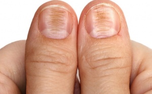 Đường vân trên móng tay của bạn cảnh báo điều gì?