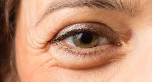 Thực phẩm nào có thể gây bọng mắt?