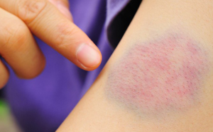 Trẻ em bị bầm tím, cha mẹ chớ chủ quan!