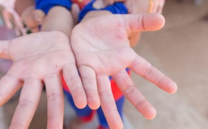 Những thông tin cần biết khi chăm sóc trẻ bị tay chân miệng