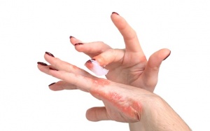 Các loại tinh dầu tốt cho người bệnh eczema