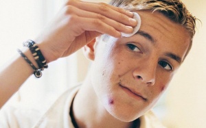 Nguyên nhân nào khiến mụn trứng cá tuổi dậy thì trở nên tồi tệ hơn? 