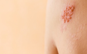 Làm sao để giảm đau khi mắc bệnh zona? 