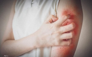 Nổi mề đay có phải do dùng thuốc điều trị đái tháo đường