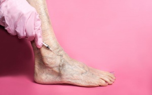 6 lầm tưởng về suy giãn tĩnh mạch bạn cần quên ngay lập tức