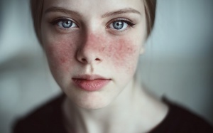 Những biện pháp tự nhiên giảm lupus