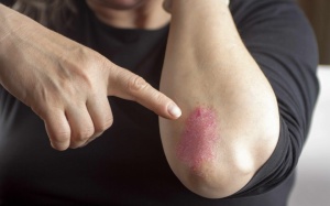 Video: Viêm khớp vẩy nến là gì, điều trị như thế nào?