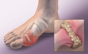 Những sự thật thú vị về bệnh gout