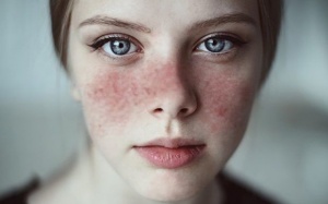 7 thông tin cần biết về bệnh lupus