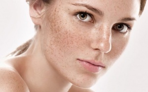 Tất tần tật những thông tin cần biết về tàn nhang