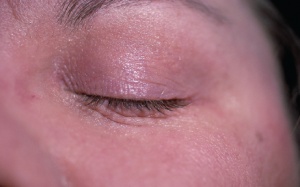 Chàm xung quanh mắt, đừng quên kem thảo dược Eczestop