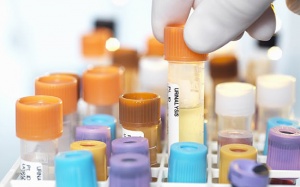 Xét nghiệm nước tiểu giúp phát hiện ung thư tuyến tụy từ giai đoạn sớm