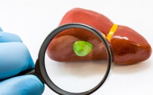 Bạn có nằm trong số những người có nguy cơ cao bị sỏi mật?