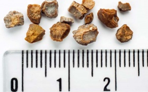 Video: Phòng bệnh sỏi thận đúng cách như thế nào?