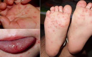 Bệnh tay chân miệng ở trẻ có nguy hiểm? 