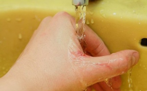 Dùng gel Subạc có làm dịu vết đốt của kiến ba khoang?