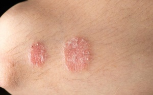 6 tác nhân có thể gây bùng phát bệnh vẩy nến