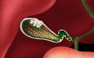 Đa polyp túi mật: Triệu chứng cảnh báo và cách điều trị hiệu quả