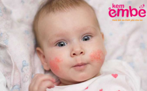 Thực hư bí quyết hỗ trợ điều trị chàm sữa trẻ sơ sinh bằng sản phẩm chiết xuất từ thảo dược