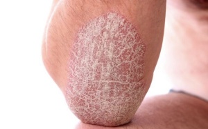 Da có vảy trắng, ngứa có phải là dấu hiệu vảy nến?